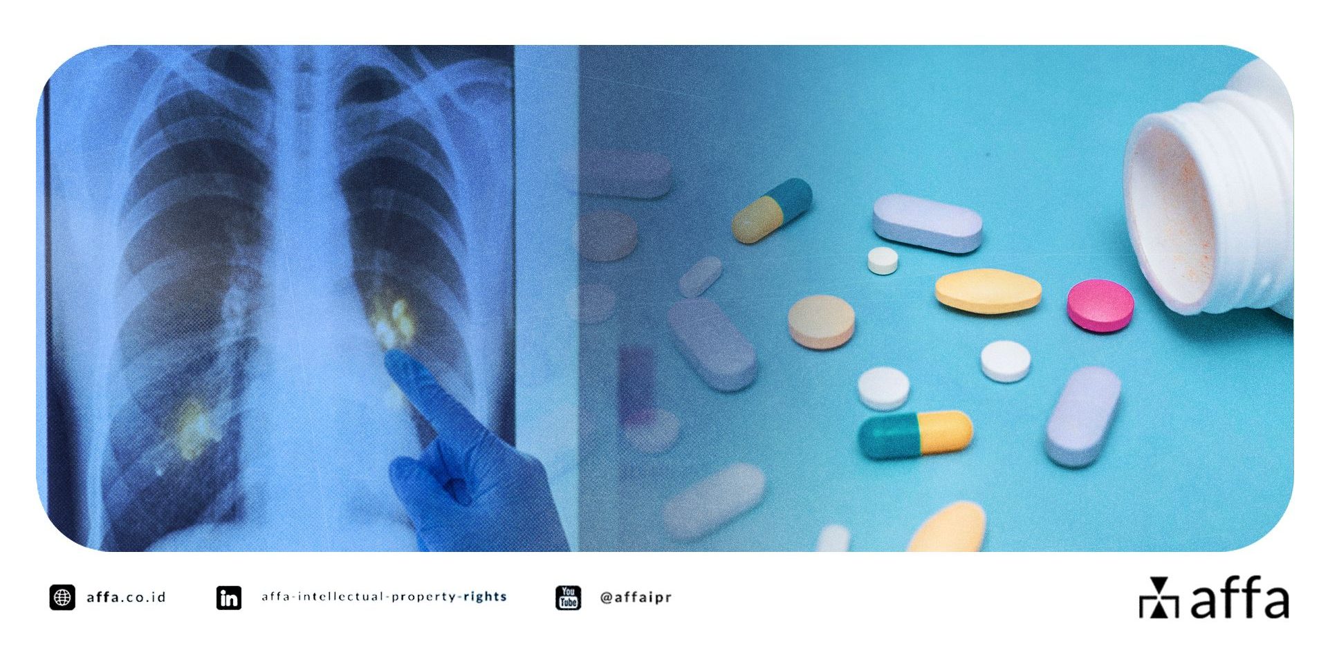 a-new-wave-of-tuberculosis-rnd-in-indonesia-industry-must-stay-alert-drug-patents-are-heating-up-affa A New Wave of Tuberculosis R&D in Indonesia: Industry Must Stay Alert—Drug Patents Are Heating Up! - AFFA IPR