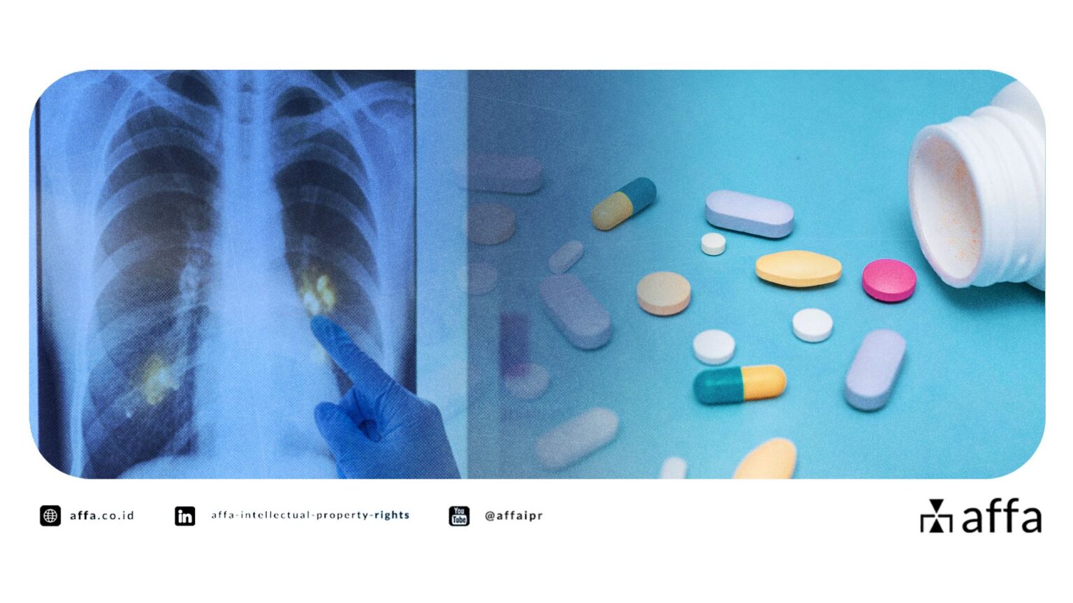 Gelombang Baru R&D TBC di Indonesia: Industri Harus Waspada, Paten Obat Akan Memanas! - AFFA IPR